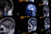 AI Achieves 93% Accuracy in Predicting Alzheimer's Disease Through Brain Scans
