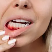 Bleeding Gums Could Signal Vitamin C Deficiency, Experts Warn