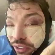 Bobby Norris Swollen and Bruised After Face and Neck Lift Surgery