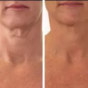 Boots Discounts PRAI Neck Cream, Mum Claims It Erased 'Turkey Neck'