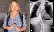 EastEnders Star Rita Simmons to Undergo Breast Reduction for Scoliosis Pain Relief