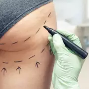 Exclusive: Nearly 500 Britons Faced Death from Liquid Brazilian Butt Lifts in Two Years