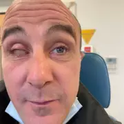 Father Loses Eye After Holiday Pool Volleyball Accident with Stranger's Nail