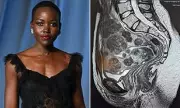 Lupita Nyong'o Reveals 77 Uterine Fibroids Battle in Emotional Birthday Essay
