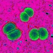 Meningitis Case Confirmed in Cork Student, No Link to UK Outbreak