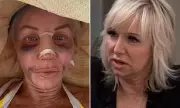 RHONJ Star Margaret Josephs Reveals Nose Job as Anti-Ageing Trend Surges