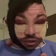 TOWIE's Bobby Norris Stuns Fans with Bruised Post-Surgery Appearance