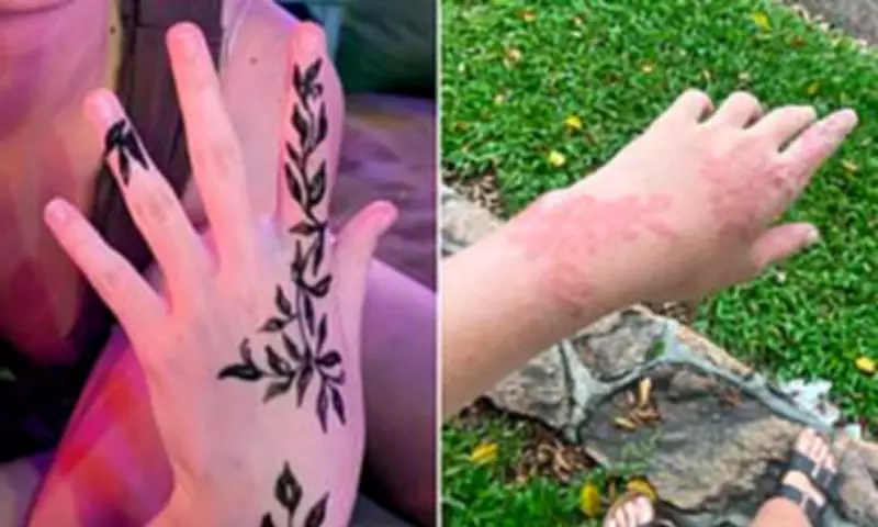 Australian Mother's Bali Henna Warning After Daughter's Severe Skin Reaction
