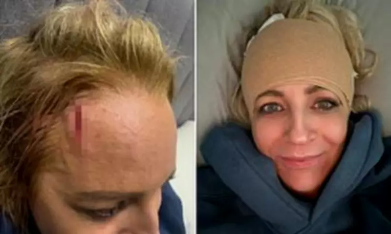 Carrie Bickmore Shares Graphic Head Injury Photos After Wall Collision