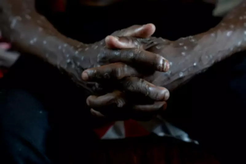 Congo Declares End to Two-Year Mpox Outbreak After Over 2,200 Suspected Deaths