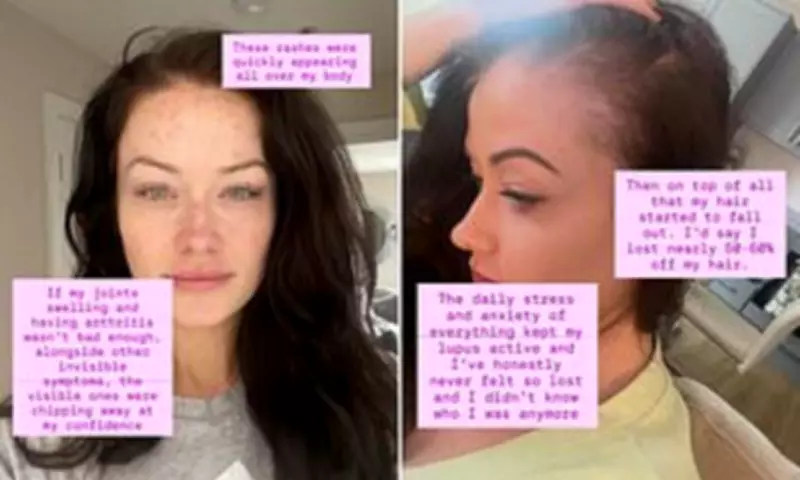 Jess Impiazzi Shares Candid Lupus Battle with Skin Rashes and Hair Loss Photos