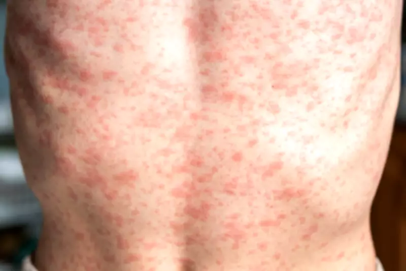 Measles Outbreaks Surge in US as Vaccination Rates Decline
