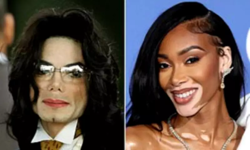 Michael Jackson Biopic Sparks New Interest in Vitiligo Condition