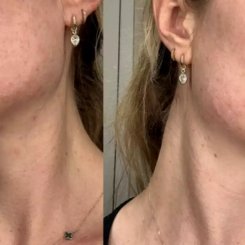 Pregnancy Acne Nightmare: A Beauty Editor's Journey to Clear Skin