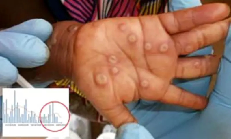San Francisco Confirms First Case of Dangerous Mpox Strain Amid Rising US Trend