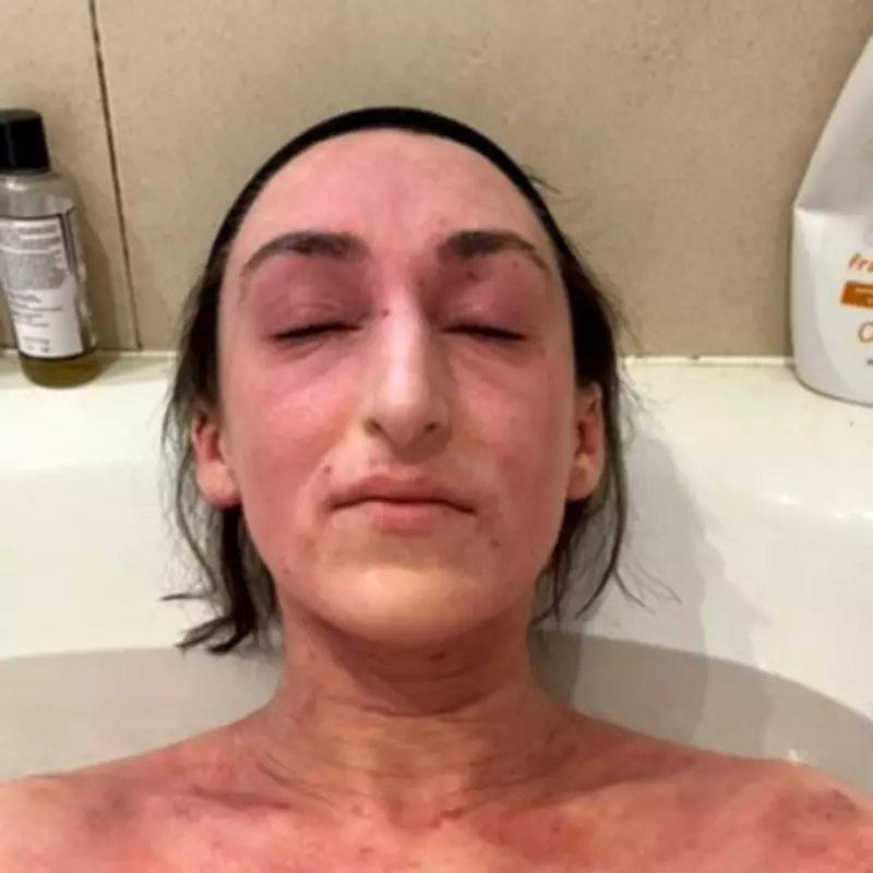 Woman's 28-Year Steroid Cream Use Leads to Severe Skin Condition