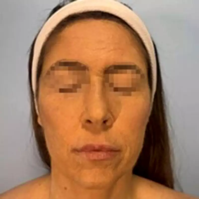 Woman's Face Severely Blistered After Reaction to Depression Drug Lamotrigine