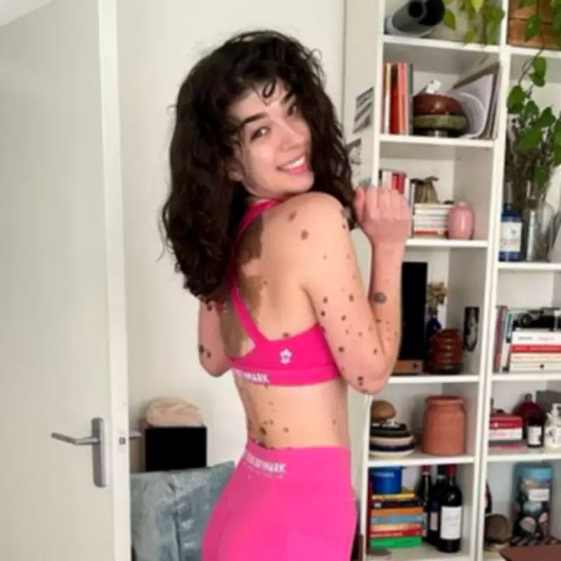 Women with Rare Birthmarks Run London Half Marathon to Challenge Stigma