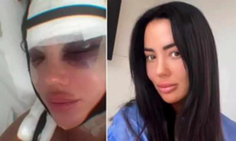 Yazmin Oukhellou Reveals Bruised Facelift Results After Turkey Surgery