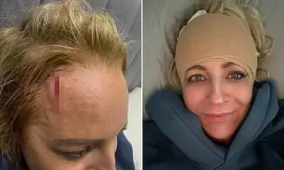 Carrie Bickmore Shares Graphic Head Injury Photos After Wall Collision