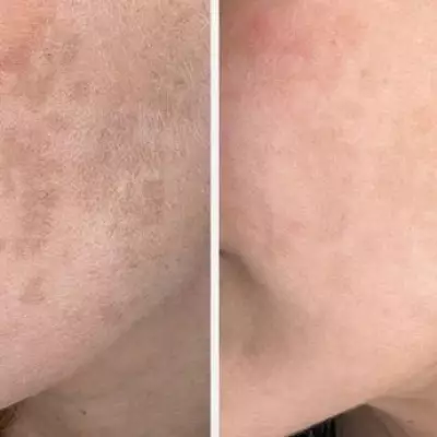 Dermatologist's New Serum Targets 'Zombie Cells' to Fade Dark Spots