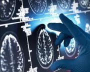 Cochrane Review Finds Alzheimer's Anti-Amyloid Drugs Have 'Trivial' Clinical Impact