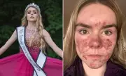 From Pageant Queen to Acne Warrior: Zoe Morgan's Journey of Self-Discovery