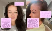 Jess Impiazzi Shares Candid Lupus Battle with Skin Rashes and Hair Loss Photos