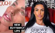 Katie Price Debuts Butterfly Lips After Second Procedure in Dubai