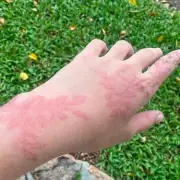 Mother's Bali Henna Warning: Temporary Tattoo Could Cause Permanent Scarring