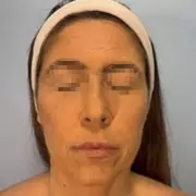 Woman's Face Severely Blistered After Reaction to Depression Drug Lamotrigine