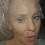 Woman's Tanning Bed Warning: Decades of Use Lead to Permanent Skin Damage