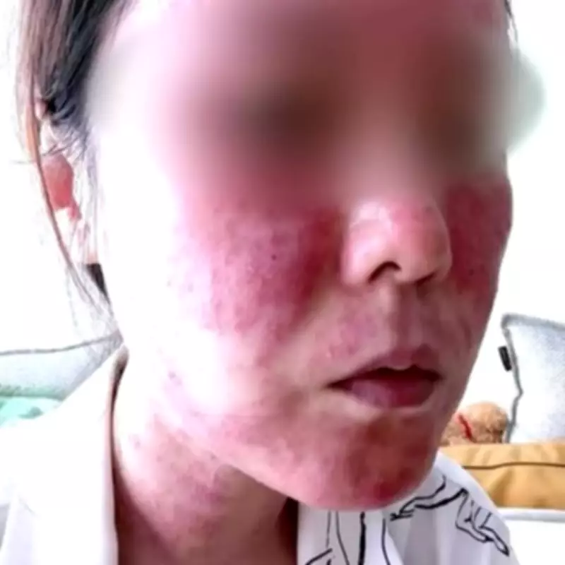 Bride Left 'Disfigured and Almost Blind' After Botched Microneedling