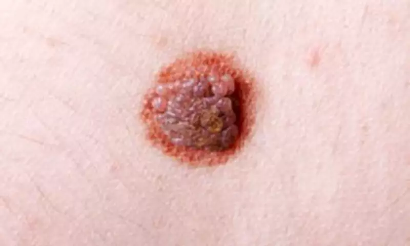Global Melanoma Cases Predicted to Surge 50% by 2050, Study Warns