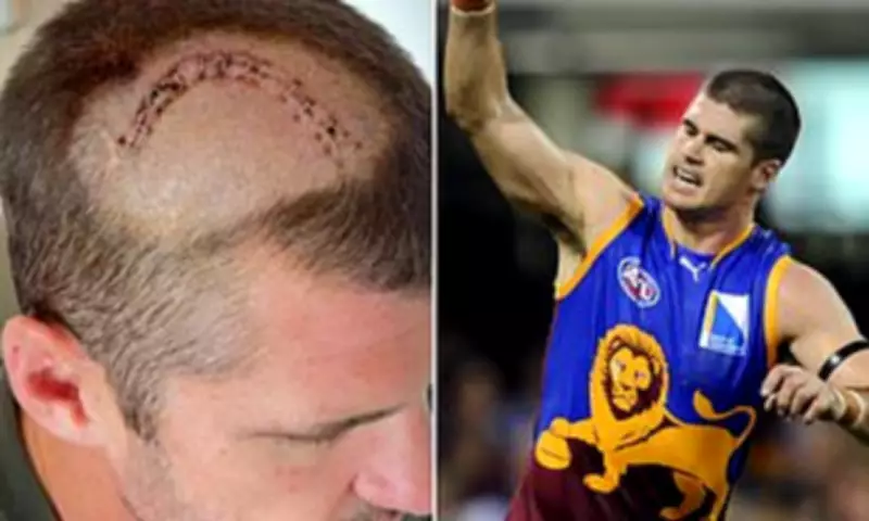 Jonathan Brown's Brain Tumour Not Linked to AFL Concussions, Doctors Confirm