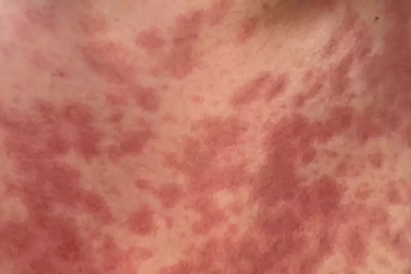Meningitis B Symptoms: Fourth Case Confirmed in Reading Outbreak