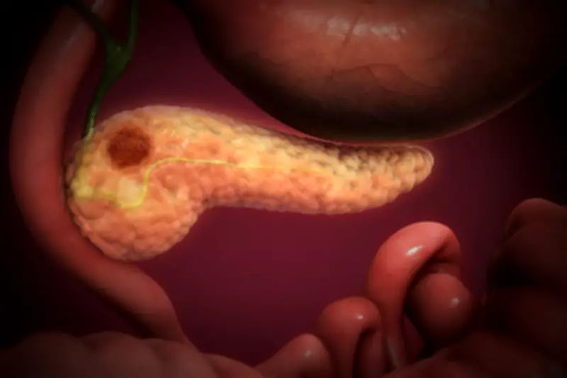 New Drug Daraxonrasib Doubles Survival in Advanced Pancreatic Cancer