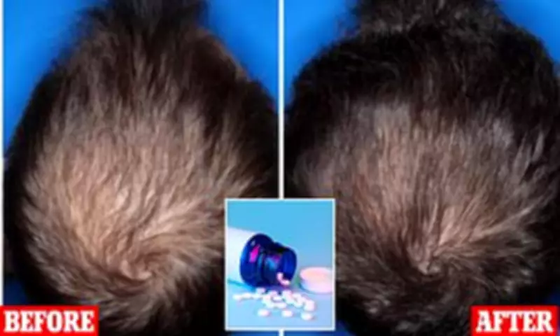 New Oral Minoxidil Shows Dramatic Hair Regrowth in Trial
