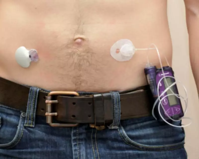 NHS Artificial Pancreas Rollout Reduces Diabetes Care Inequality
