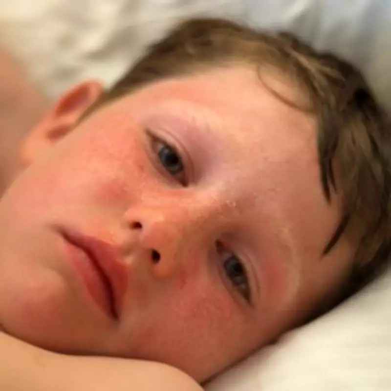 NHS Issues Sunburn Treatment Guide After UK Heatwave