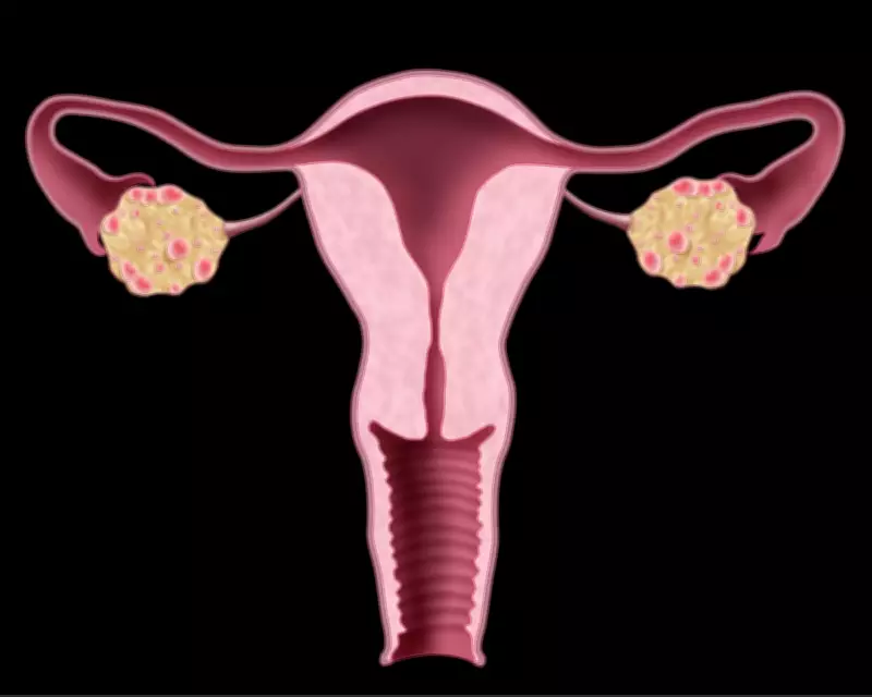 NHS Urged to Update Website After Renaming PCOS to PMOS