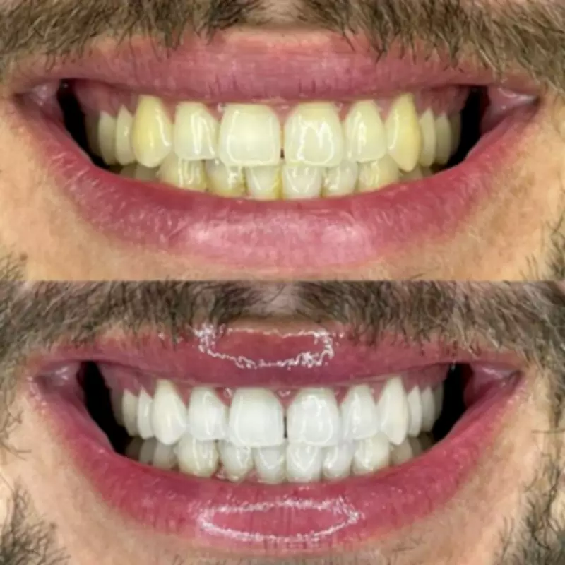 Smoker and Coffee Drinker Raves About 70p Teeth Whitening Strips