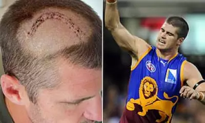 Jonathan Brown's Brain Tumour Not Linked to AFL Concussions, Doctors Confirm