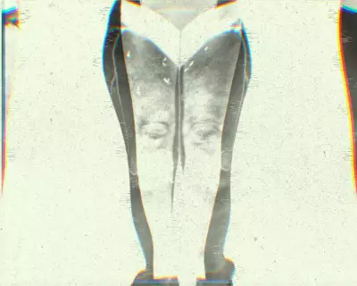 Lipedema: The Underdiagnosed Leg Condition Affecting 1 in 10 Women
