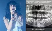 Cara Delevingne's Music Career Hits Bump with Emergency Root Canal Surgery