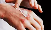 Eczema Cream Recall: Staph Contamination Found in Popular Product
