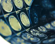Lacunar Strokes Caused by Artery Widening, Not Blockage, Study Finds