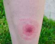 Lyme Disease Cases in England Surge by Over 20% in One Year