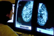 Navigating Conflicting Mammogram Guidelines: When to Get Screened