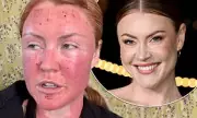 Strictly Star Chris Robshaw's Wife Camilla Kerslake Shows Severe Face Swelling After CO2 Laser